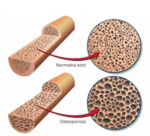 Mit in resnica o osteoporozi